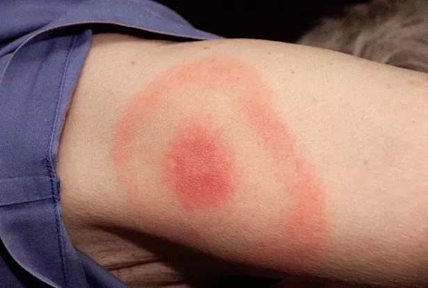 erythema-migrans.jpg