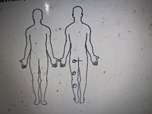 Diagram showing where Jaimeson Cody was tased on the back of his left leg after being tased at least twice on the front of the same leg.