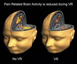 How virtual reality is revolutionizing health care