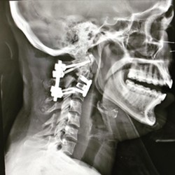 Alfonso shared this post-surgery x-ray showing where her neck was injured in the crash. - COURTESY LEXI ALFONSO