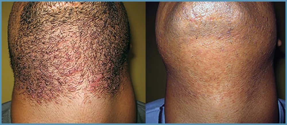 Ditch the Wax &amp; Toss the Razor—Why Laser Hair Removal is