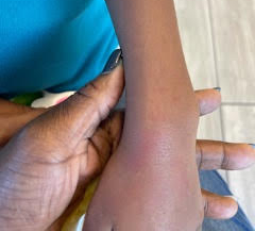 Police photographed Amaria's swollen wrists at Nicklaus Children's Hospital after a September 2021 incident in which a teacher allegedly pulled her off a bus to scold her. - PHOTO COURTESY OF RAWSI WILLIAMS LAW GROUP