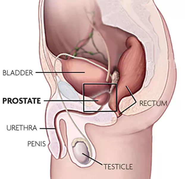 Pity the surgeon whose goal is to remove a cancerous prostate while not inflicting impotence or incontinence on the patient. - WIKIMEDIA/NORTH COAST JOURNAL