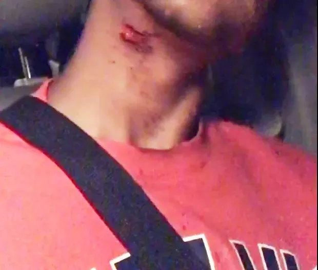 The wound on the 16 year old's neck that led to his being airlifted to the Bay Area for emergency care. - SUBMITTED