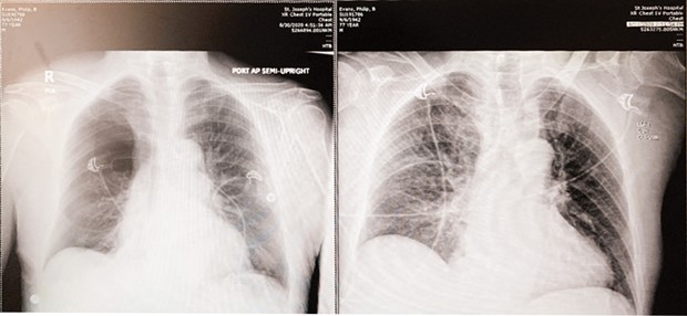 Right: X-ray taken in the ER soon after my accident shows all five lobes of my lungs (white spidery lines) filling up my entire chest cavity. Left: By the next morning my right superior lobe (top left) had collapsed. "What's that white blob in the middle?" I asked. "Your heart."