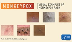 California Monkeypox Response is Bumpy, but Builds on Some Lessons from COVID