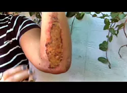 A COP DID THIS TO ME: Shortly after being arrested and charged with theft, then-21-year-old Rodia Monterrosobragg had a friend take pictures of the injuries she received from her run-in with former Paso Robles cop Jeffry Bromby. - PHOTO COURTESY OF RODIA MONTERROSOBRAGG
