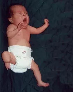 COMPLICATIONS FROM BIRTH : Jane (not her real name) was born with fibular hemimelia. - PHOTO CONTRIBUTED