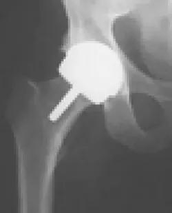 X-RAY VISION : This is an x-ray of a hip with the Birmingham Hip Resurfacing device installed inside. - PHOTO COURTESY OF BIRMINGHAM HIP RESURFACING