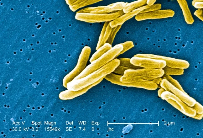 SIGNS AND SYMPTOMS: If you’ve got a cough, don’t worry. It’s probably not tuberculosis. Still, if you’d like to track the symptoms, there are a variety to watch for. - “If they’ve had a cough lasting longer than a month accompanied by weight loss, night sweats, coughing up blood—those are all concerting signs for tuberculosis in the lungs,” Dr. Charity Thoman said. - If that’s your case, contact your primary physician to get a round of testing started. - For more information, visit cdc.gov/tb/topic/basics/default.htm. - IMAGE COURTESY CENTERS FOR DISEASE CONTROL AND PREVENTION