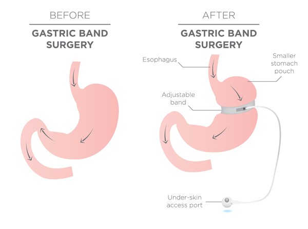 Before and After Gastric Band for Weight Loss Illustrations bigstock.com - BIGSTOCK