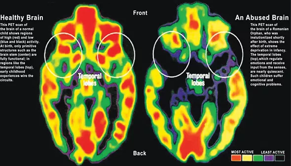 A PET scan shows the difference between the brain of a healthy child and the brain of a child who has experienced multiple ACEs. - PROVIDED