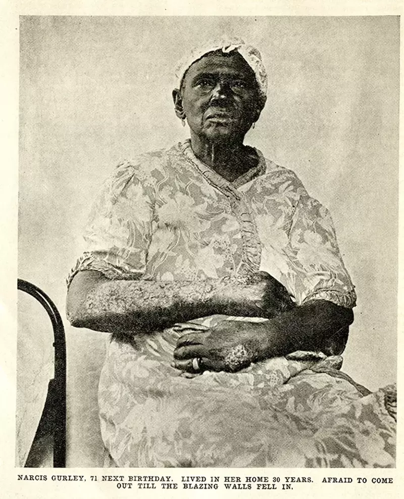 A 70 year old woman who was burned escaping her home. She'd been "afraid to come out till the blazing walls fell in," explains the original caption. - IMAGE VIA THE CRISIS