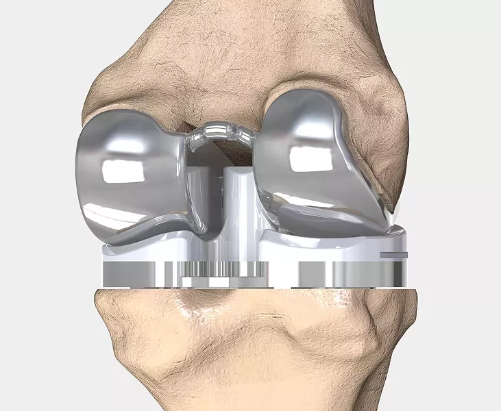 iTotal on bone