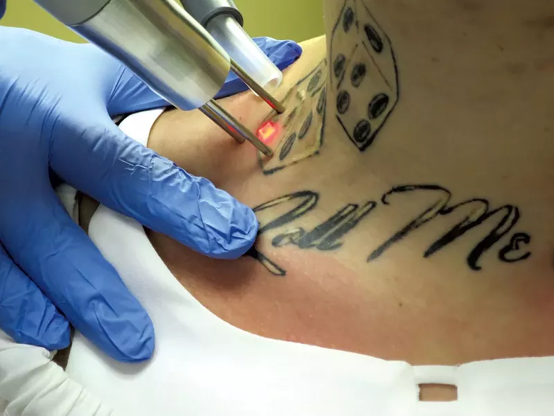 Tattoo removal - MATTHEW THORSEN