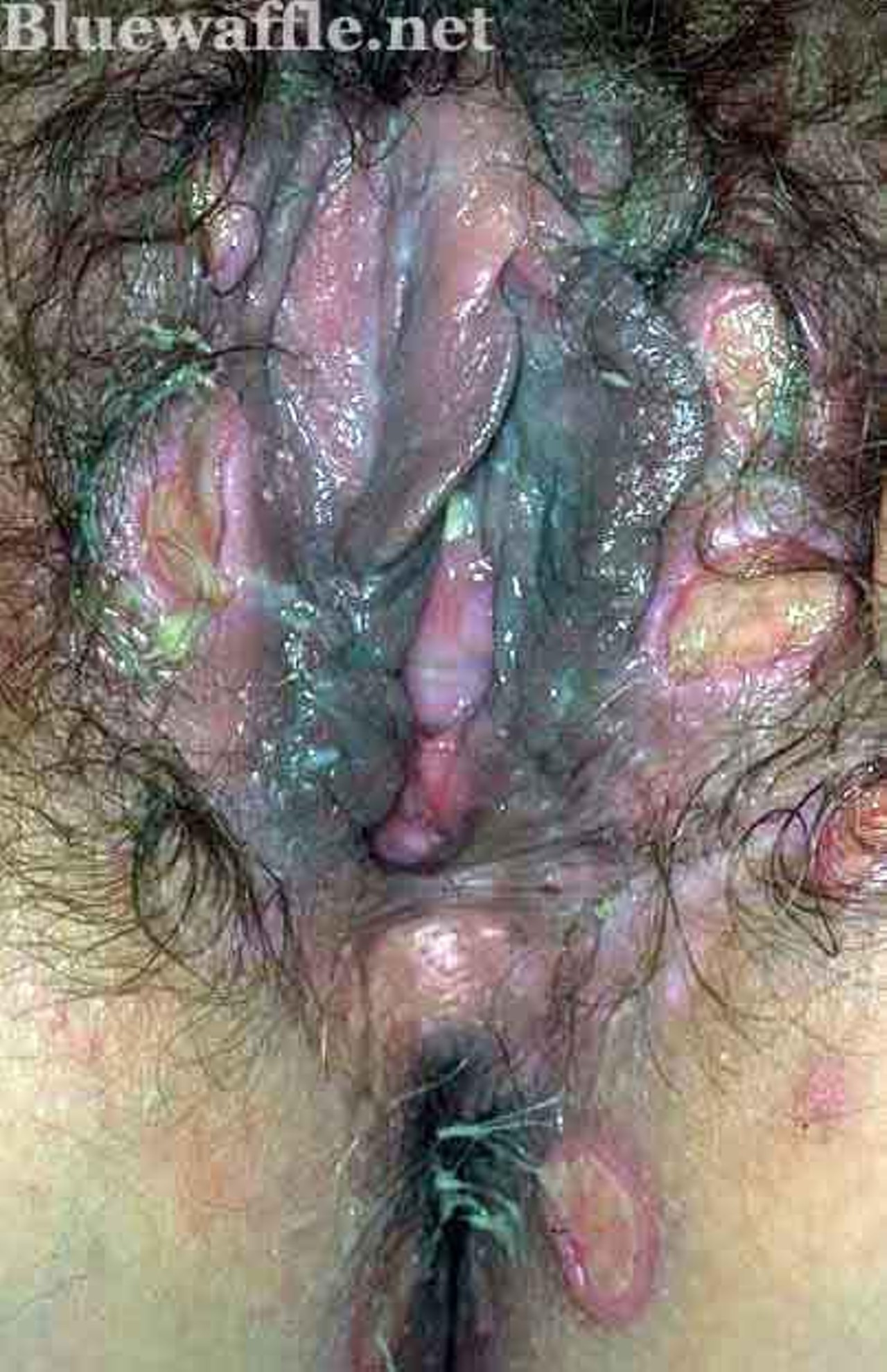 Blue wafflé disease images