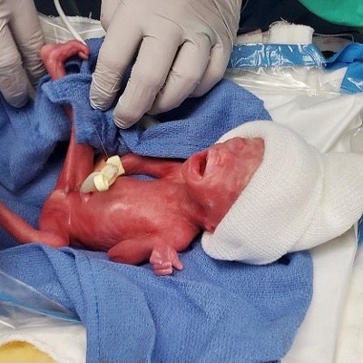 1-Pound Baby Born at Tucson Medical Center