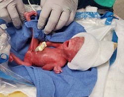 Henry Augustus Truhill was delivered at Tucson Medical Center on Feb. 1 weighing only one pound. - TUCSON MEDICAL CENTER